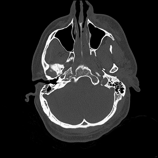 File:Bilateral occipital condyle fracture (type 2) (Radiopaedia 87675-104089 Axial bone thins 48).jpg