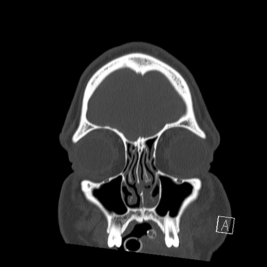 Bilateral occipital condyle fracture (type 2) (Radiopaedia 87675-104089 Coronal bone window 2).jpg