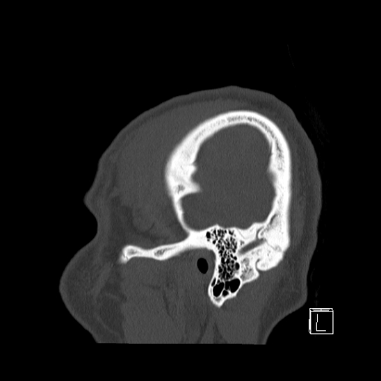 Bilateral occipital condyle fracture (type 2) (Radiopaedia 87675-104089 Sagittal bone window 110).jpg
