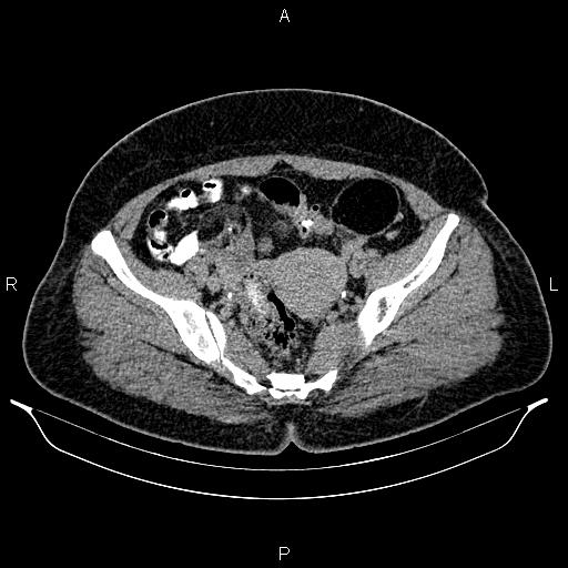 Bilateral ovarian dermoid cysts (Radiopaedia 85785-101603 Axial C+ delayed 67).jpg