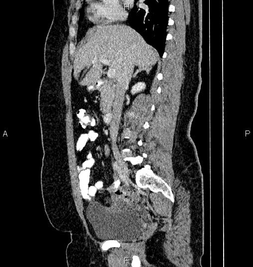 File:Bilateral ovarian dermoid cysts (Radiopaedia 85785-101603 D 36).jpg