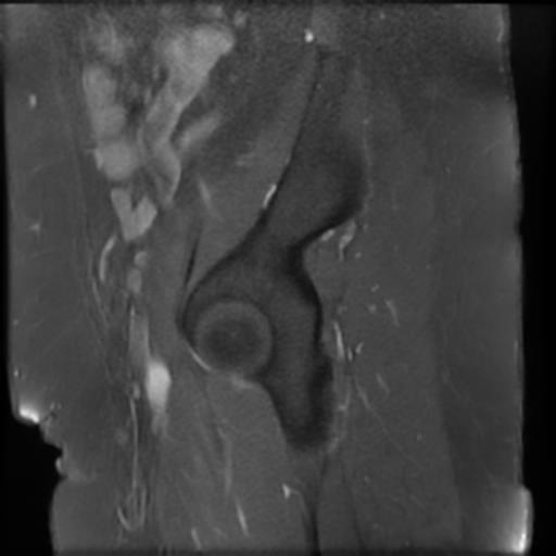 File:Bilateral ovarian dermoid cysts (Radiopaedia 90152-107338 Sagittal T1 C+ 1).jpg