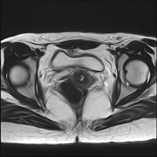 File:Bilateral ovarian endometriomas (Radiopaedia 87085-103347 Axial T2 15).jpg