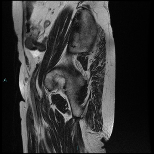File:Bilateral ovarian fibroma (Radiopaedia 44568-48293 Sagittal T2 31).jpg