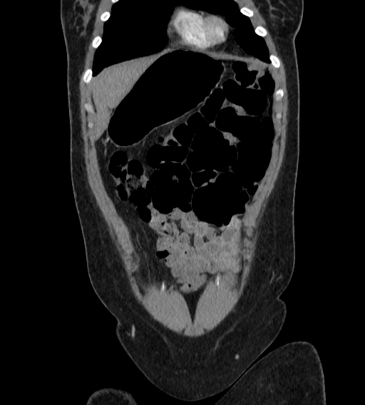 File:Bilateral ovarian mature cystic teratomas (Radiopaedia 79373-92457 B 7).jpg