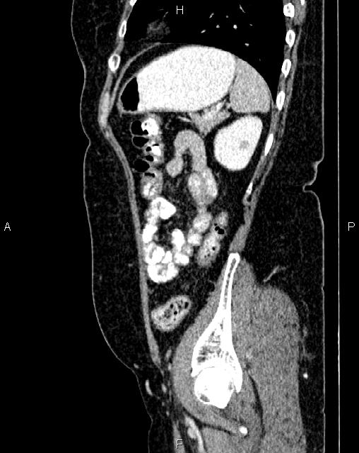 Bilateral ovarian serous cystadenocarcinoma (Radiopaedia 86062-101989 E 69).jpg