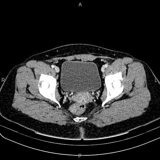 Bilateral ovarian teratoma (Radiopaedia 83131-97503 Axial With contrast 61).jpg