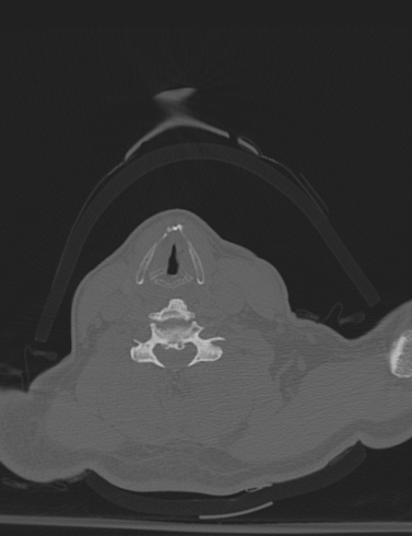 Bilateral perched facet joint (Radiopaedia 63149-71669 Axial bone window 42).jpg