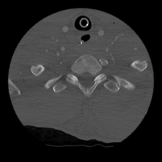 Bilateral perched facets with cord injury (Radiopaedia 45587-49713 Axial bone window 97).jpg