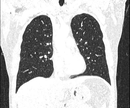 Bilateral pulmonary AVM (Radiopaedia 83134-97505 Coronal lung window 37).jpg