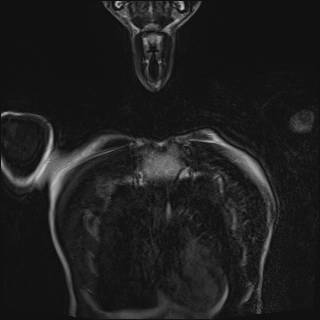Bilateral spinoglenoid notch ganglion cysts (Radiopaedia 29577-30082 Coronal T2 13).jpg