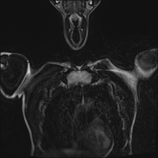 File:Bilateral spinoglenoid notch ganglion cysts (Radiopaedia 29577-30082 Coronal T2 18).jpg