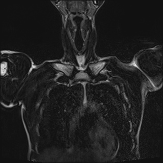 Bilateral spinoglenoid notch ganglion cysts (Radiopaedia 29577-30082 Coronal T2 25).jpg