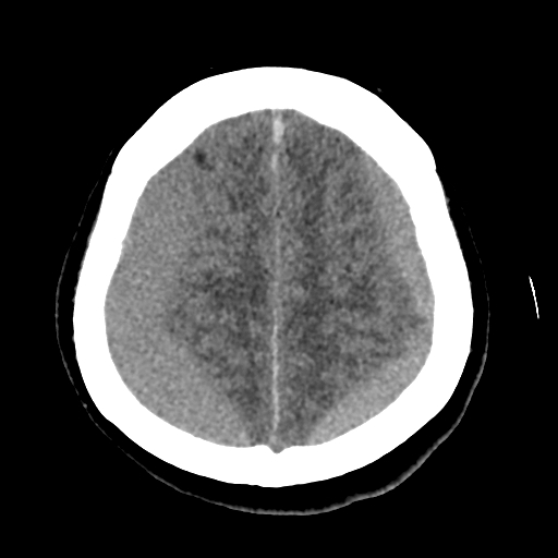 Bilateral subacute subdural hematoma (Radiopaedia 69240-79018 Axial non-contrast 40).jpg