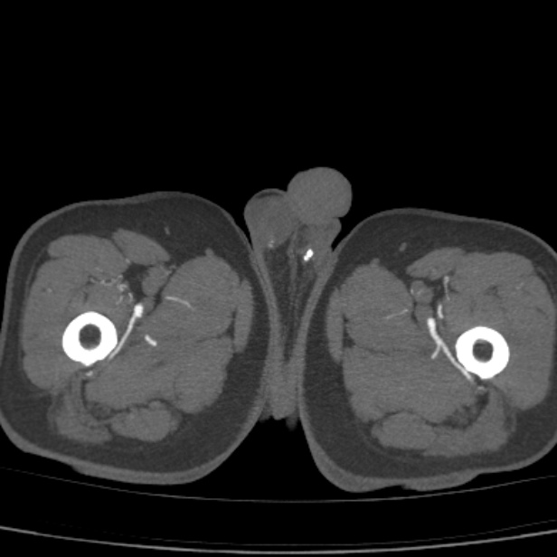 Bilateral superficial femoral arterial occlusion (Radiopaedia 25682-25857 A 34).jpg