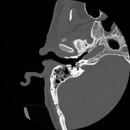 File:Bilateral temporal bone fractures (Radiopaedia 29482-29970 Axial non-contrast 13).jpg