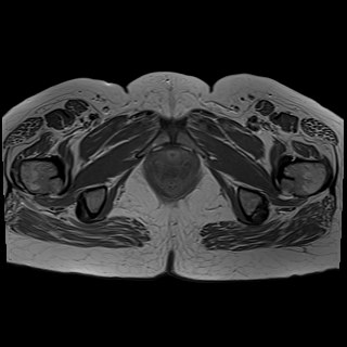 Bilateral tubo-ovarian abscesses (Radiopaedia 58635-65829 Axial T1 C+ 46).jpg