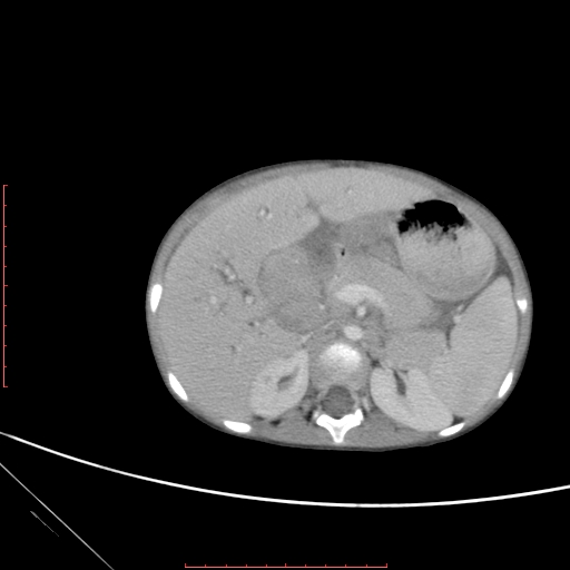 Biliary tract embryonal rhabdomyosarcoma (Radiopaedia 51815-57648 A 37).jpg