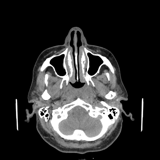 File:Bisphosphonate-related osteonecrosis of the jaw (Radiopaedia 71324-81642 non-contrast 136).jpg