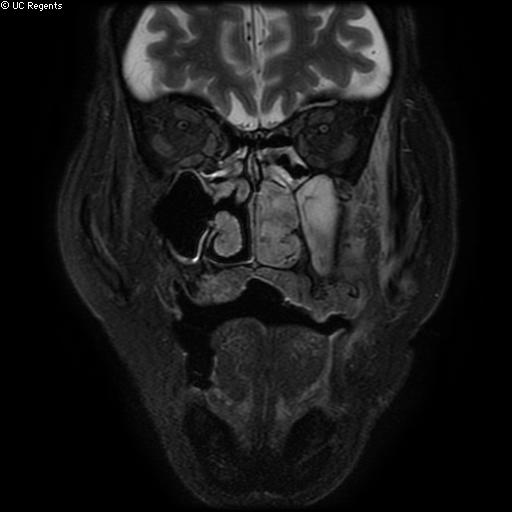 File:Bisphosphonate-related osteonecrosis of the maxilla (Radiopaedia 51367-57101 Coronal T2 fat sat 19).jpg