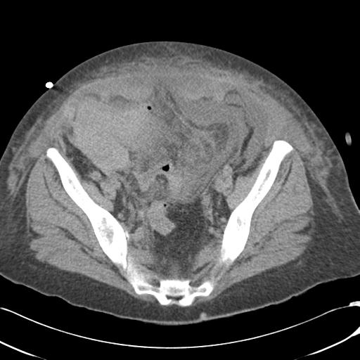 Bladder rupture post renal biopsy (Radiopaedia 30863-31572 Axial non-contrast 70).jpg