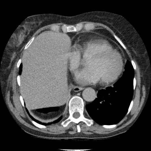 Bladder tumor detected on trauma CT (Radiopaedia 51809-57609 C 12).jpg