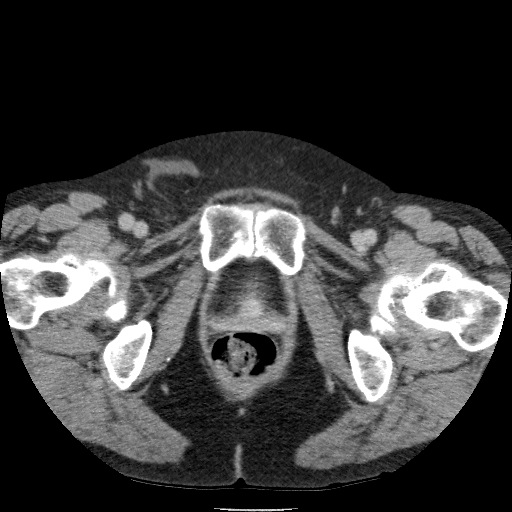 Bladder tumor detected on trauma CT (Radiopaedia 51809-57609 C 141).jpg
