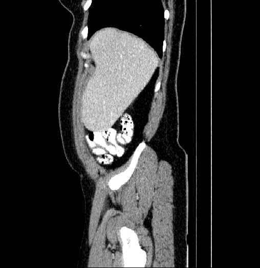 Blind-ending branch of a bifid ureter (Radiopaedia 61159-69048 B 5).jpg