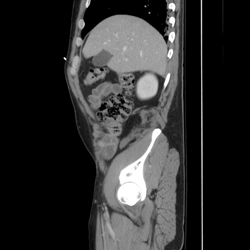 Blunt abdominal trauma with solid organ and musculoskelatal injury with active extravasation (Radiopaedia 68364-77895 C 42).jpg