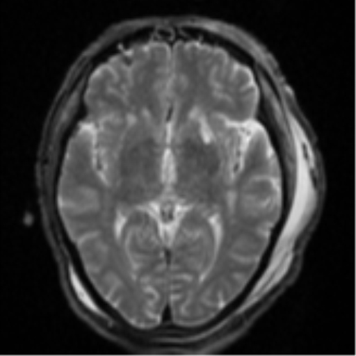 Blunt cerebrovascular injury (Radiopaedia 53682-59745 Axial DWI 15).png