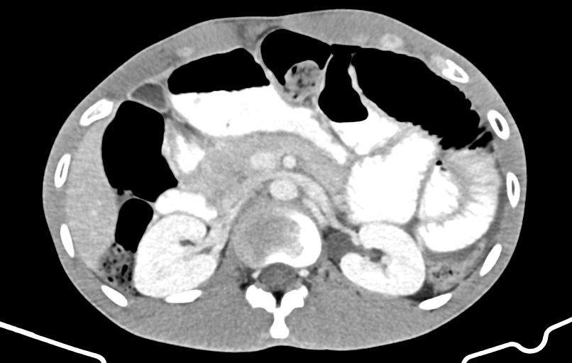 Blunt injury to the small bowel (Radiopaedia 74953-85987 A 53).jpg