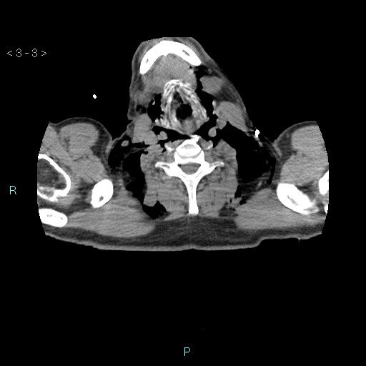 Boerhaave syndrome (Radiopaedia 27683-27897 oral contrast 3).jpg