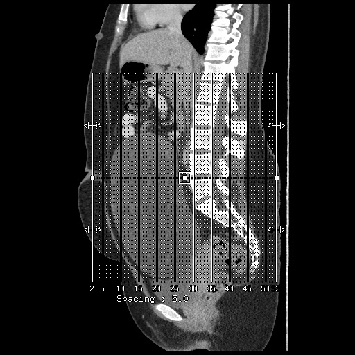 Borderline mucinous tumor (ovary) (Radiopaedia 78228-90808 C 1).jpg