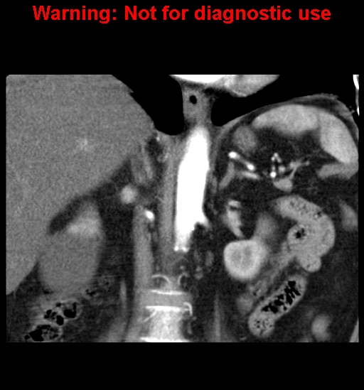 File:Bosniak renal cyst - type II (Radiopaedia 23404-23468 C 12).jpg