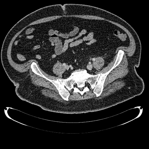 Bosniak renal cyst - type IV (Radiopaedia 24244-24518 C 294).jpg