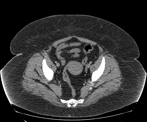 Bowel and splenic infarcts in acute lymphocytic leukemia (Radiopaedia 61055-68913 A 107).jpg