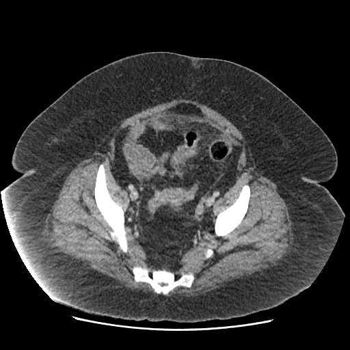 Bowel and splenic infarcts in acute lymphocytic leukemia (Radiopaedia 61055-68915 A 110).jpg