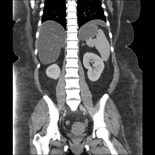 Bowel and splenic infarcts in acute lymphocytic leukemia (Radiopaedia 61055-68915 B 41).jpg