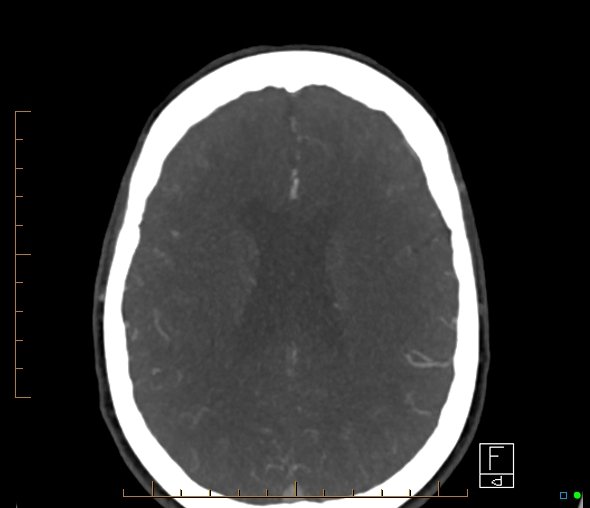 Brachiocephalic trunk stenosis (Radiopaedia 87242-103519 A 25).jpg