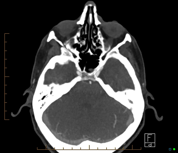 Brachiocephalic trunk stenosis (Radiopaedia 87242-103519 A 49).jpg