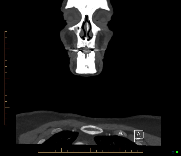 Brachiocephalic trunk stenosis (Radiopaedia 87242-103519 B 4).jpg