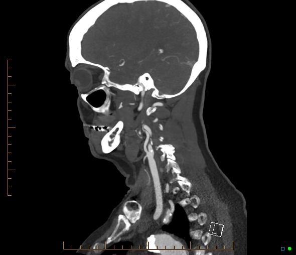 Brachiocephalic trunk stenosis (Radiopaedia 87242-103519 C 20).jpg