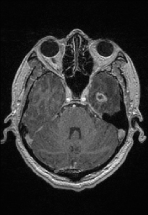 Brain abscess with ventriculitis (Radiopaedia 85703-101495 Axial T1 C+ 56).jpg