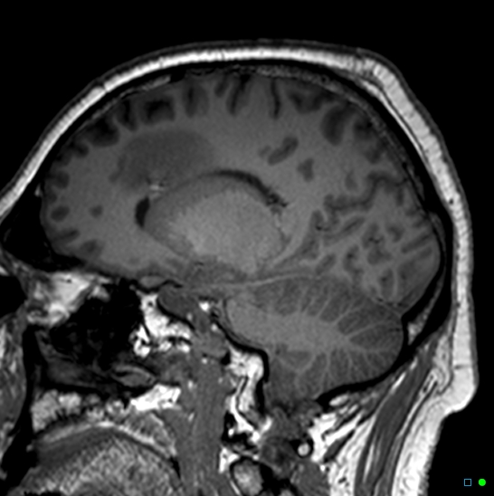 Brain death on MRI and CT angiography (Radiopaedia 42560-45689 Sagittal T1 10).jpg