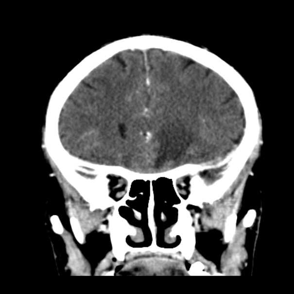 Brain metastases from lung cancer (Radiopaedia 24480-24781 Coronal C+ delayed 19).jpg