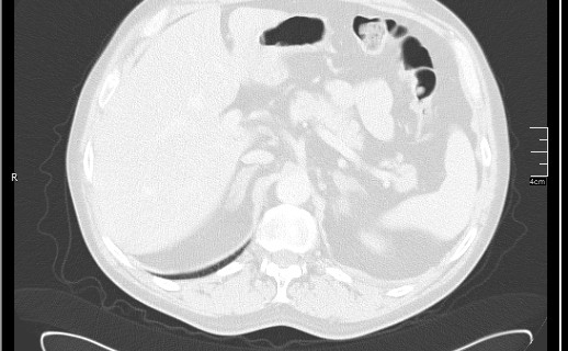 File:Brain metastases from squamocellular lung cancer (Radiopaedia 56515-63219 Axial lung window 63).jpg