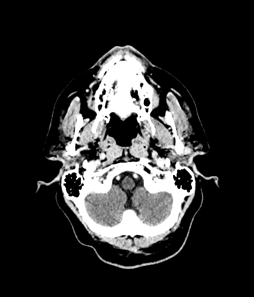 Brain metastasis (large cystic mass) (Radiopaedia 47497-52106 Axial C+ 12).png
