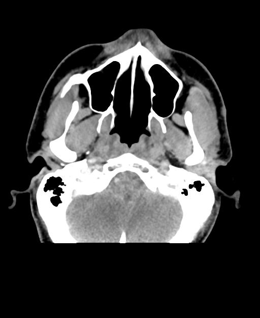 Branchial cleft cyst (Radiopaedia 31167-31875 Axial C+ delayed 5).jpg