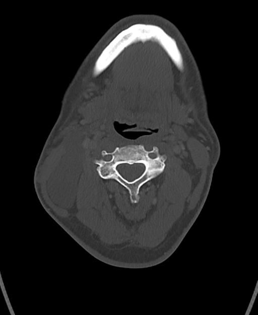 Branchial cleft cyst (Radiopaedia 31167-31875 Axial bone window 32).jpg