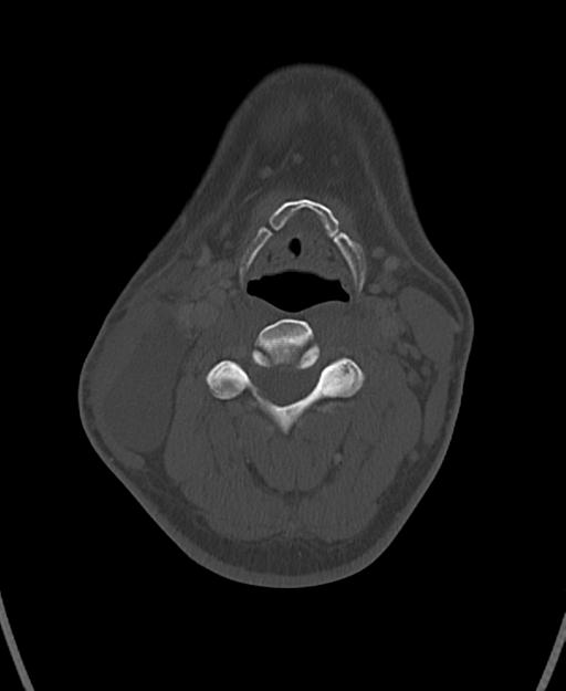 Branchial cleft cyst (Radiopaedia 31167-31875 Axial bone window 36).jpg
